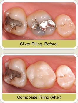 What is a Tooth Filling? White Tooth Fillings are Healthy and Durable